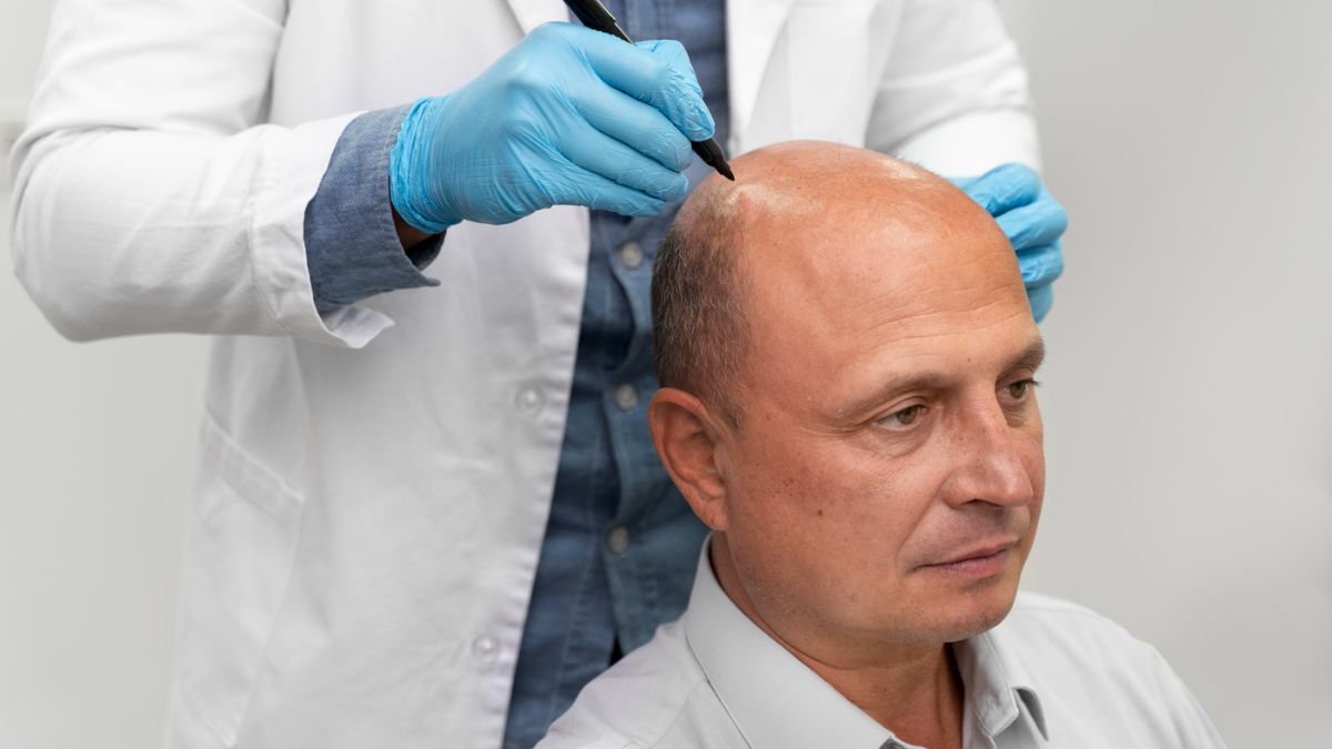 Strip Hair Transplant 