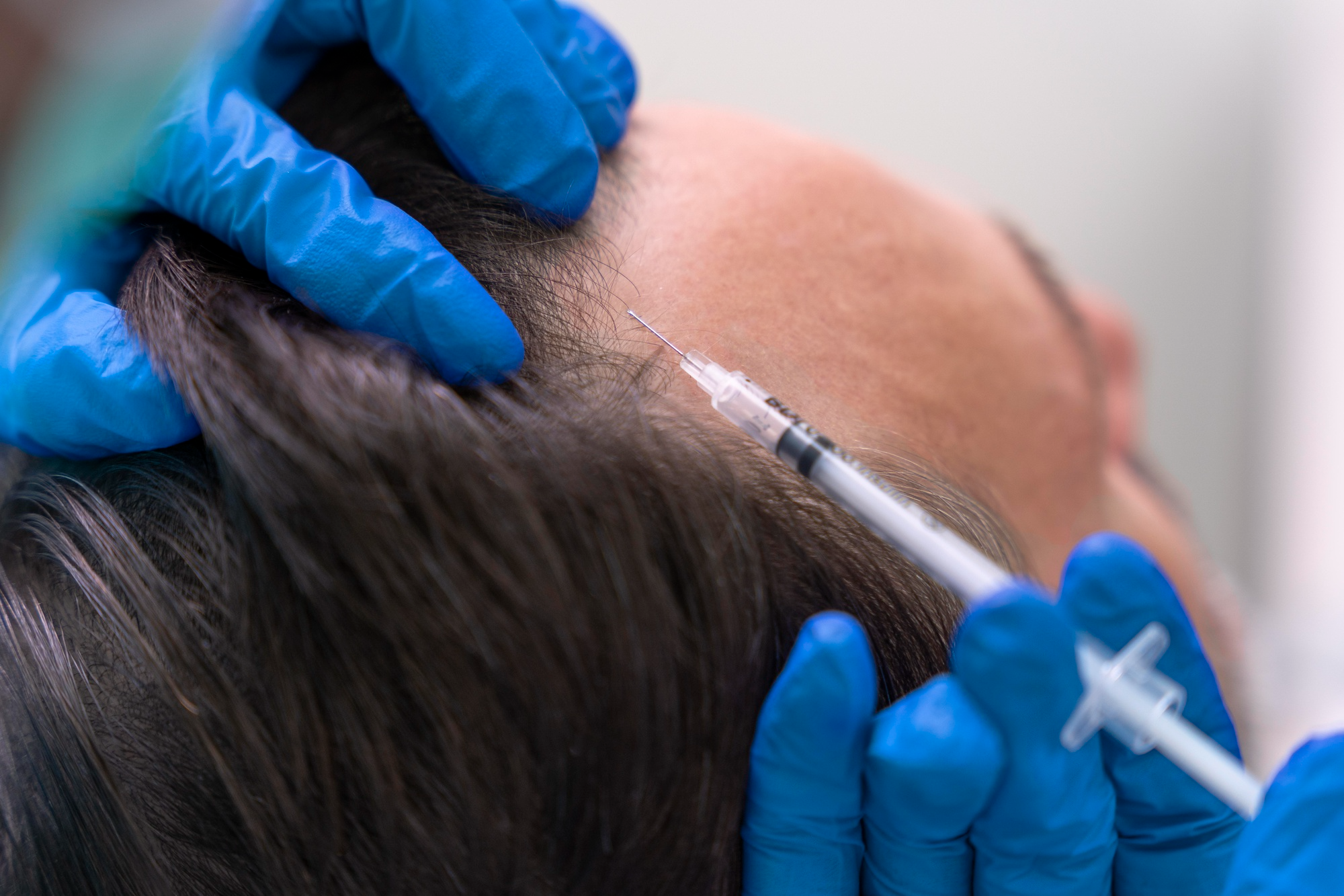 Therapy for Hair Loss